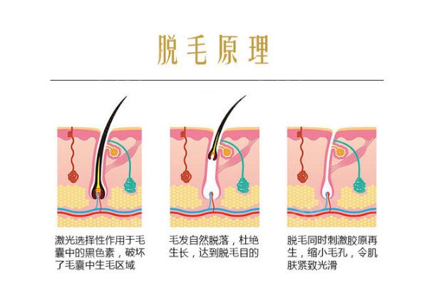 激光脱毛有烧焦的味道 脱毛仪为什么会有烧焦味