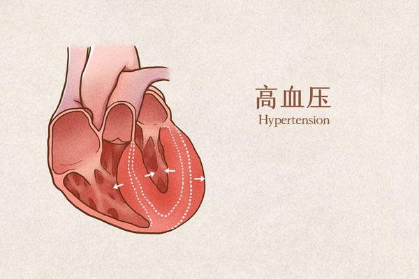 600高血压医疗插画示意图（企业商用）.jpg